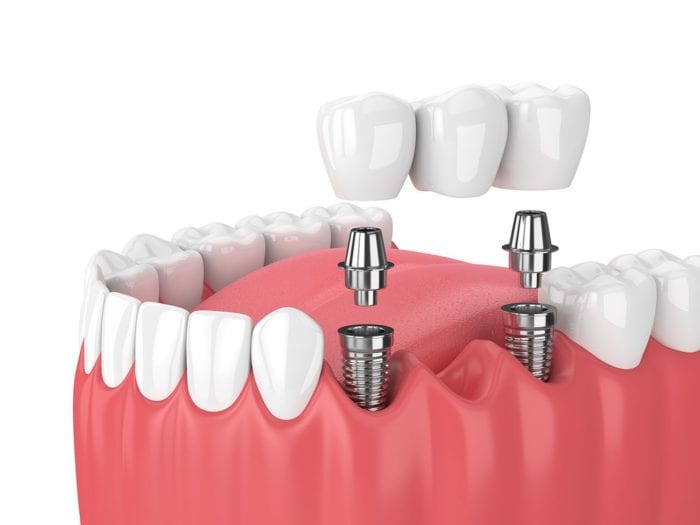 Dental Implants Techniques