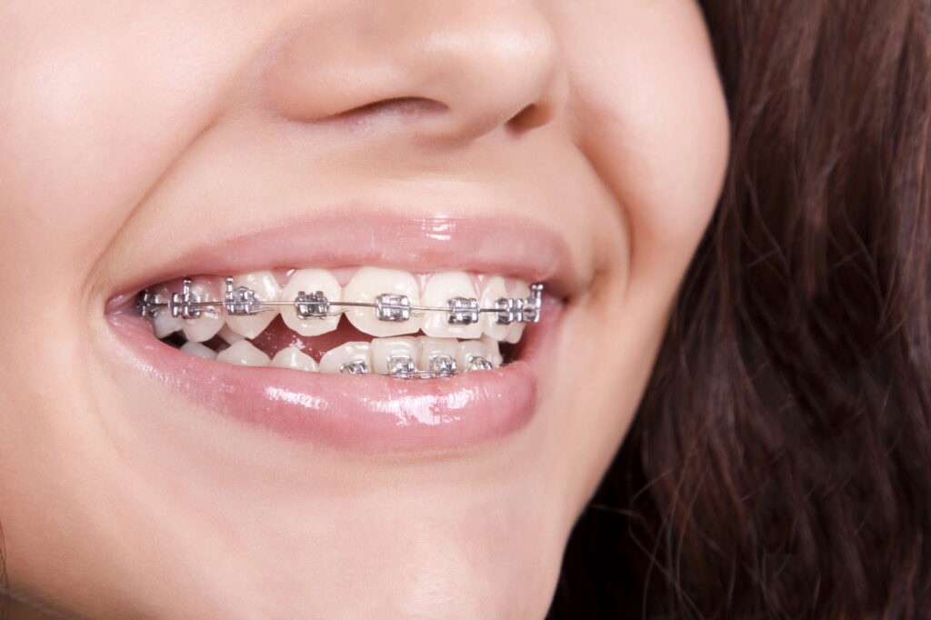 Orthodontic treatment