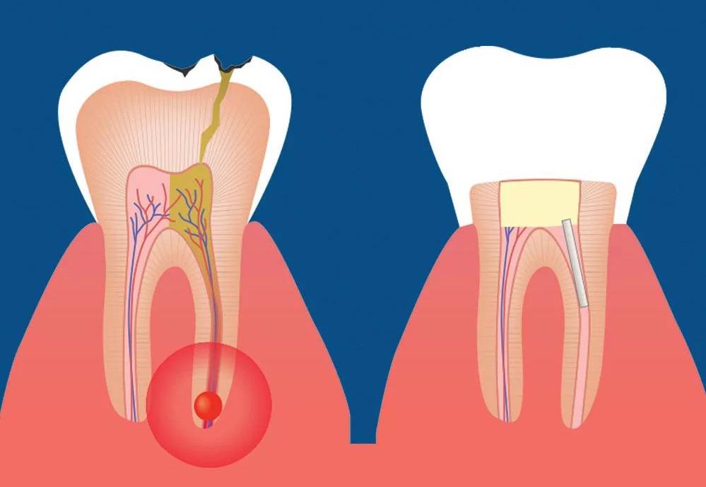 Root canal treatment 1