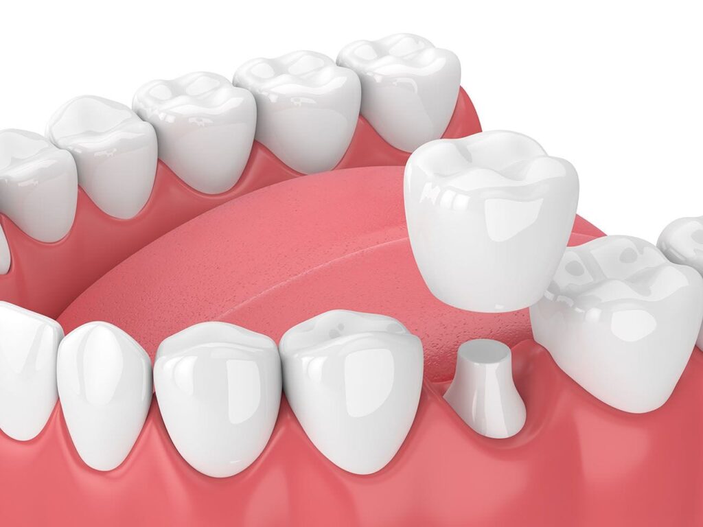 Zirconium Crowns